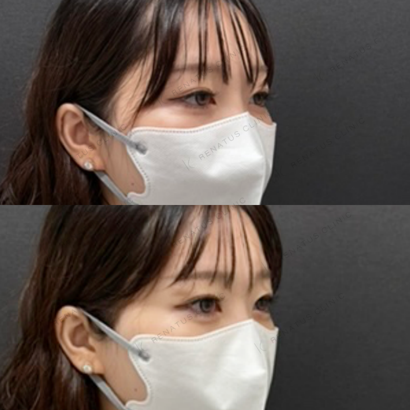 福岡_914_副田Dr_涙袋_ヒアルロン酸_女性_23_斜め右 涙袋ヒアルロン酸症例写真