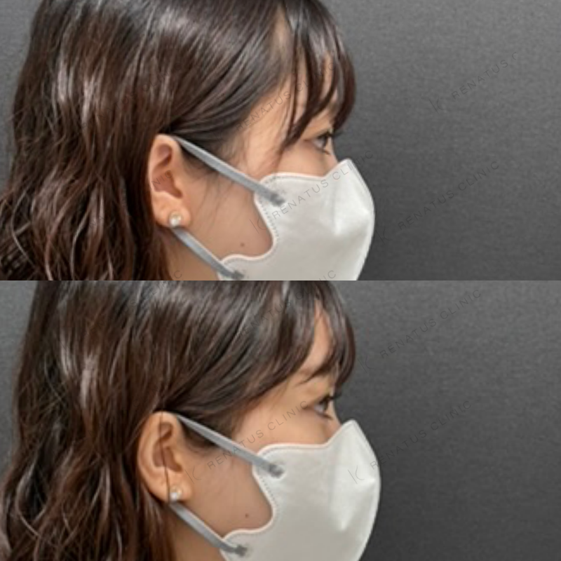 福岡_914_副田Dr_涙袋_ヒアルロン酸_女性_23_右 涙袋ヒアルロン酸症例写真