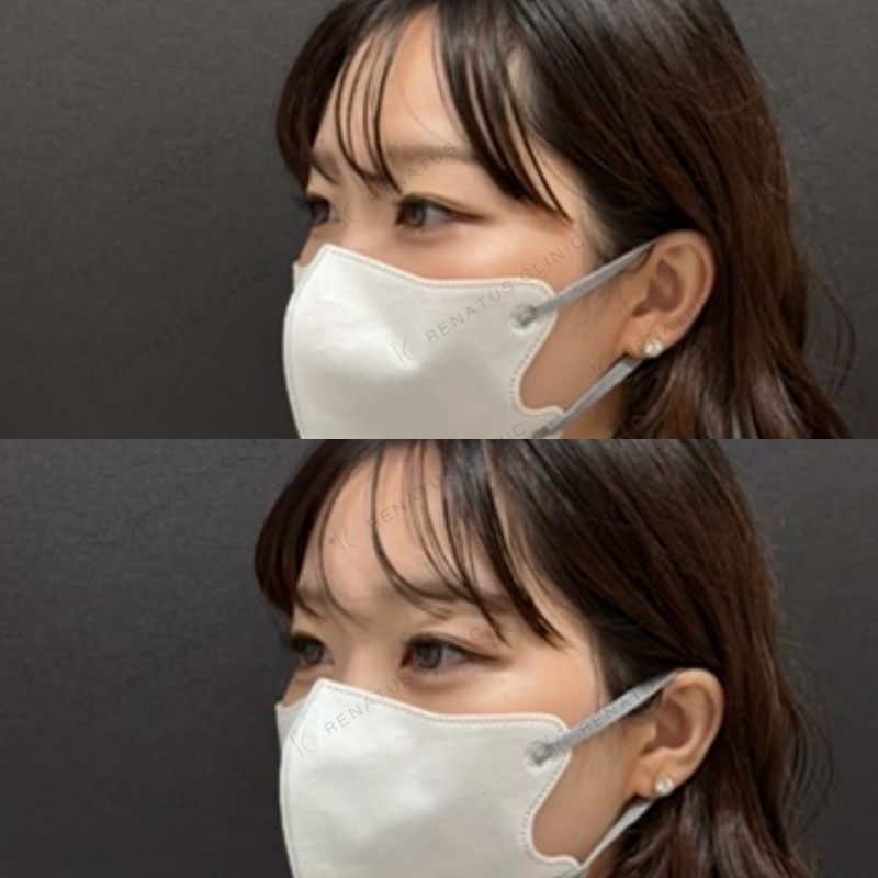 福岡_914_副田Dr_涙袋_ヒアルロン酸_女性_23_斜め左 涙袋ヒアルロン酸症例写真