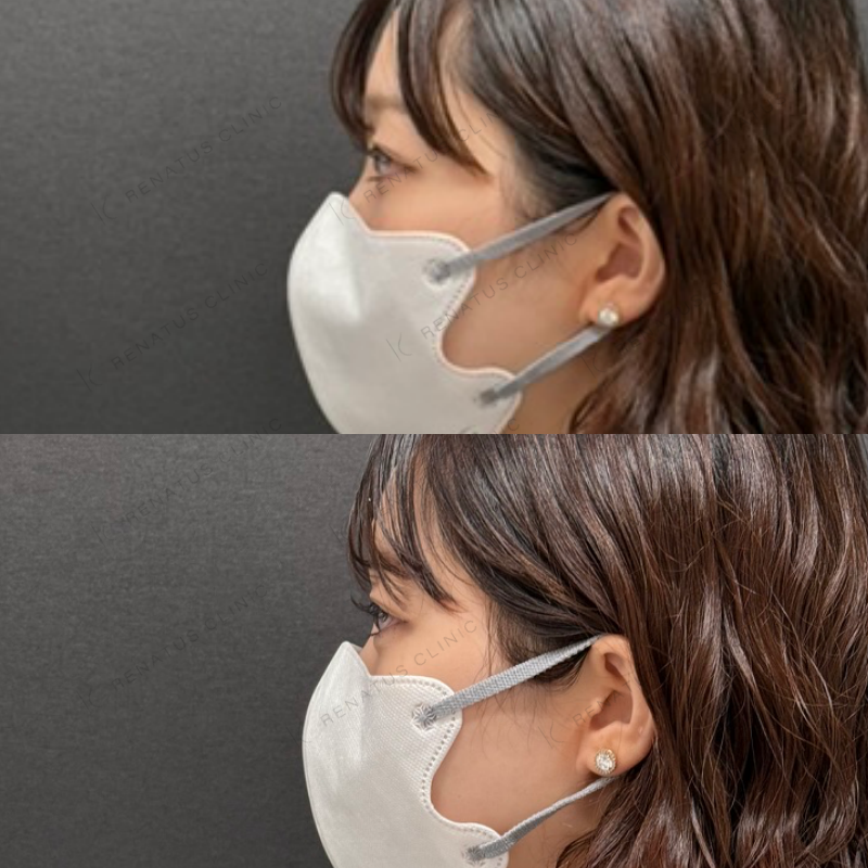 福岡_914_副田Dr_涙袋_ヒアルロン酸_女性_23_左 涙袋ヒアルロン酸症例写真