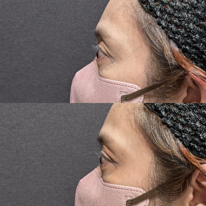 目の上ヒアルロン酸ボルベラ症例写真 目の上ヒアルロン酸ボルベラ症例写真