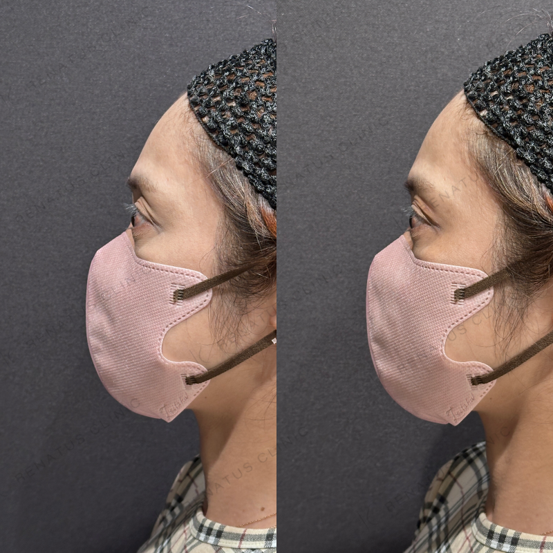 目の上ヒアルロン酸ボルベラ症例写真 目の上ヒアルロン酸ボルベラ症例写真