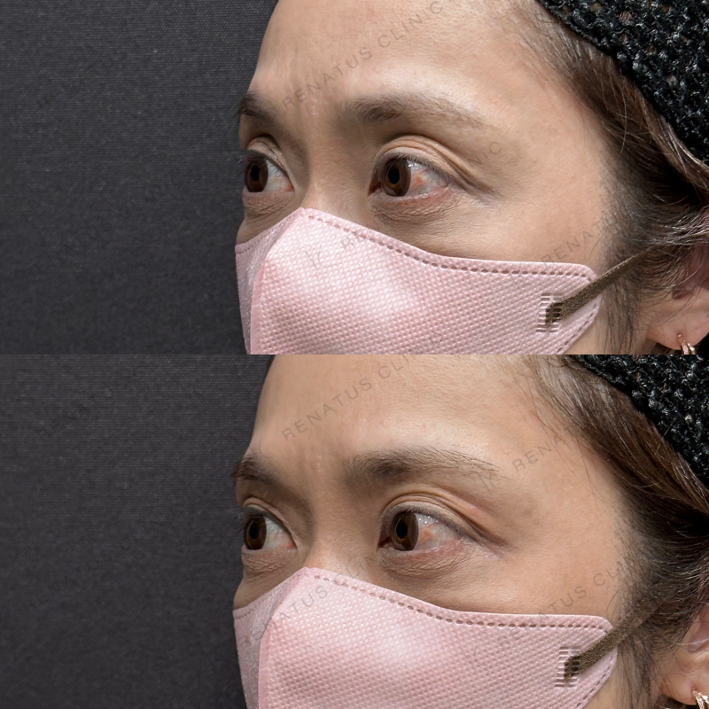 目の上ヒアルロン酸ボルベラ症例写真 目の上ヒアルロン酸ボルベラ症例写真