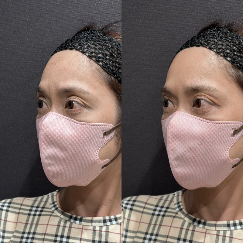 目の上ヒアルロン酸ボルベラ症例写真 目の上ヒアルロン酸ボルベラ症例写真