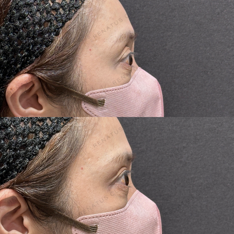 目の上ヒアルロン酸ボルベラ症例写真 目の上ヒアルロン酸ボルベラ症例写真