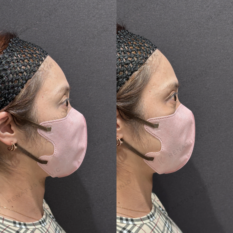 目の上ヒアルロン酸ボルベラ症例写真 目の上ヒアルロン酸ボルベラ症例写真