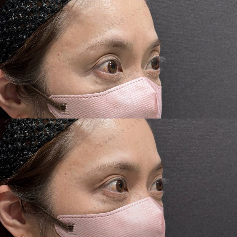 目の上ヒアルロン酸ボルベラ症例写真 目の上ヒアルロン酸ボルベラ症例写真