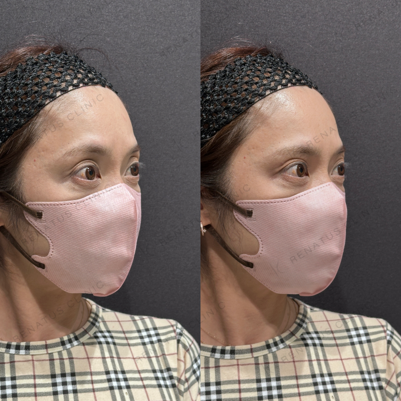 目の上ヒアルロン酸ボルベラ症例写真 目の上ヒアルロン酸ボルベラ症例写真