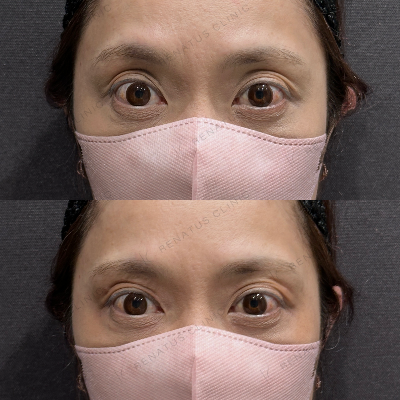 目の上ヒアルロン酸ボルベラ症例写真 目の上ヒアルロン酸ボルベラ症例写真