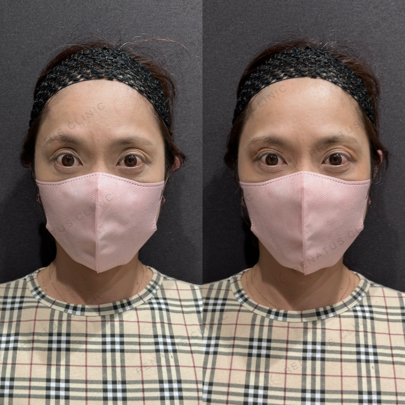 目の上ヒアルロン酸ボルベラ症例写真 目の上ヒアルロン酸ボルベラ症例写真