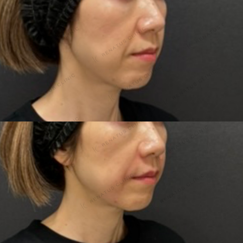 福岡_877_松村Dr_鼻翼基部_ボリューマ_女性_52_斜め右 鼻翼基部ヒアルロン酸ボリューマ症例写真