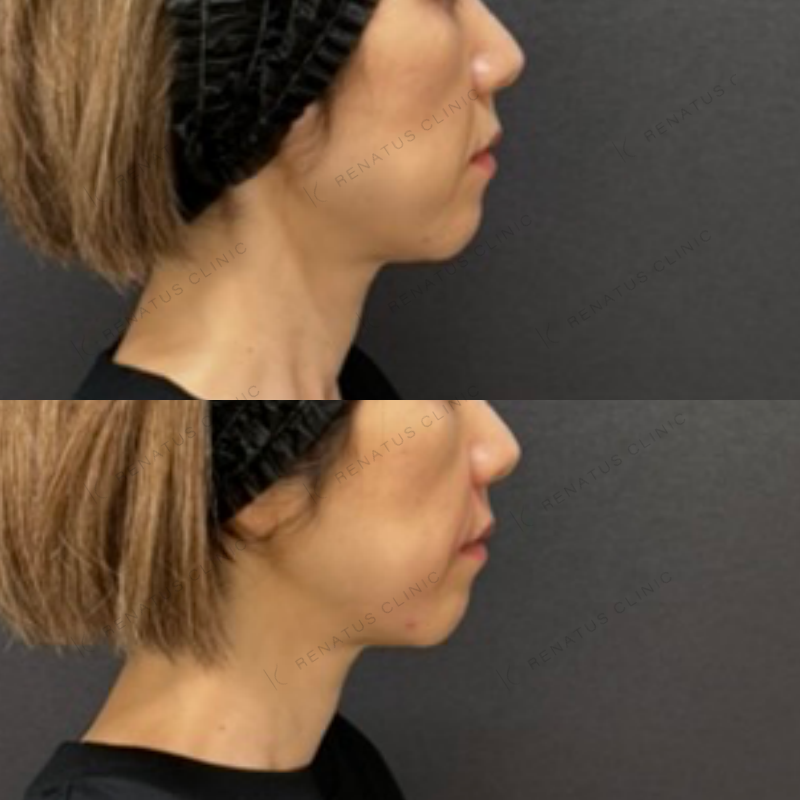 福岡_877_松村Dr_鼻翼基部_ボリューマ_女性_52_右 鼻翼基部ヒアルロン酸ボリューマ症例写真