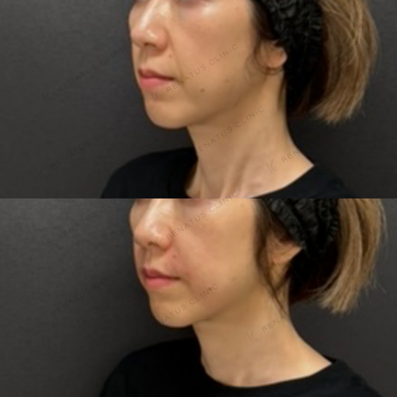 福岡_877_松村Dr_鼻翼基部_ボリューマ_女性_52_斜め左 鼻翼基部ヒアルロン酸ボリューマ症例写真