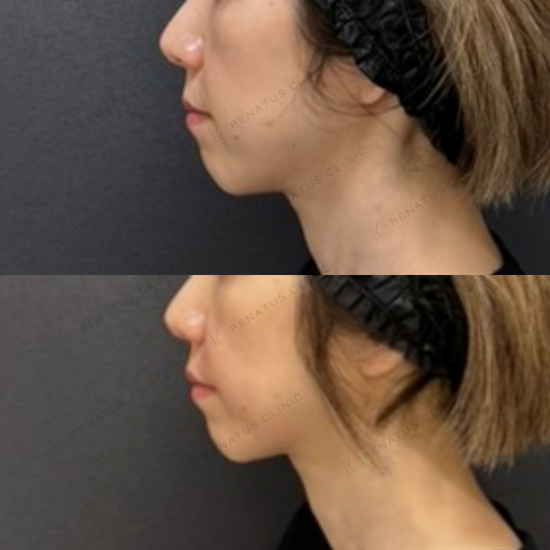 福岡_877_松村Dr_鼻翼基部_ボリューマ_女性_52_左 鼻翼基部ヒアルロン酸ボリューマ症例写真