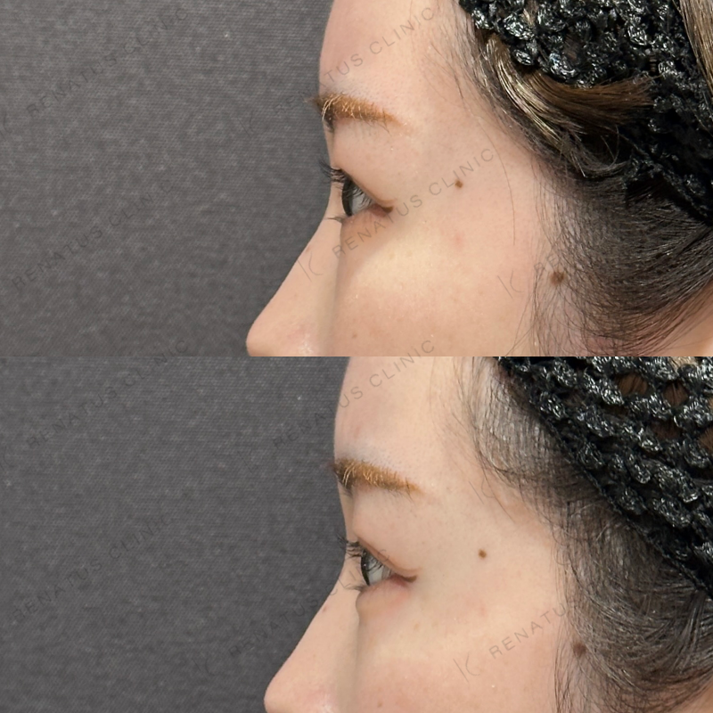 涙袋ヒアルロン酸ボルベラ症例写真 涙袋ヒアルロン酸ボルベラ症例写真