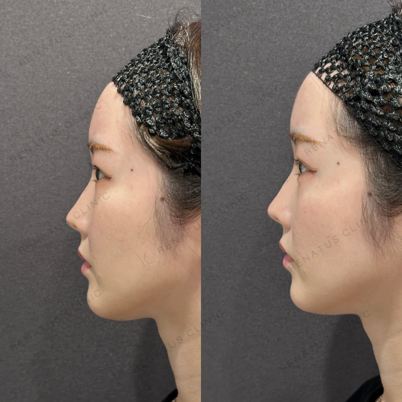 涙袋ヒアルロン酸ボルベラ症例写真 涙袋ヒアルロン酸ボルベラ症例写真