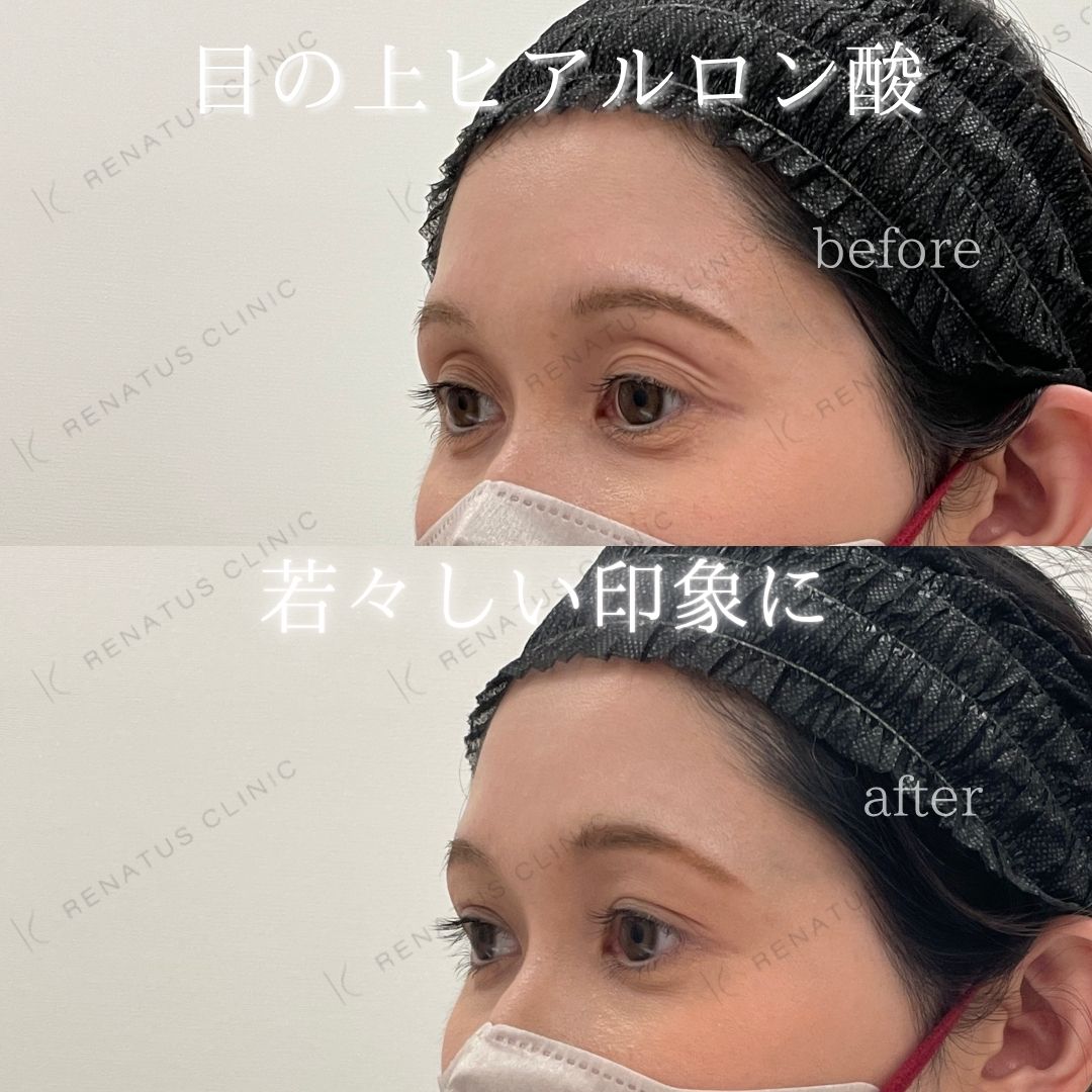 目の上ボルベラヒアルロン酸 目の上ボルベラヒアルロン酸