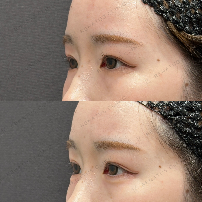 涙袋ヒアルロン酸ボルベラ症例写真 涙袋ヒアルロン酸ボルベラ症例写真