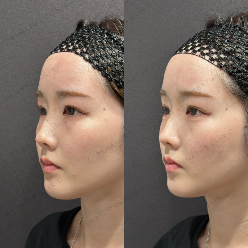 涙袋ヒアルロン酸ボルベラ症例写真 涙袋ヒアルロン酸ボルベラ症例写真