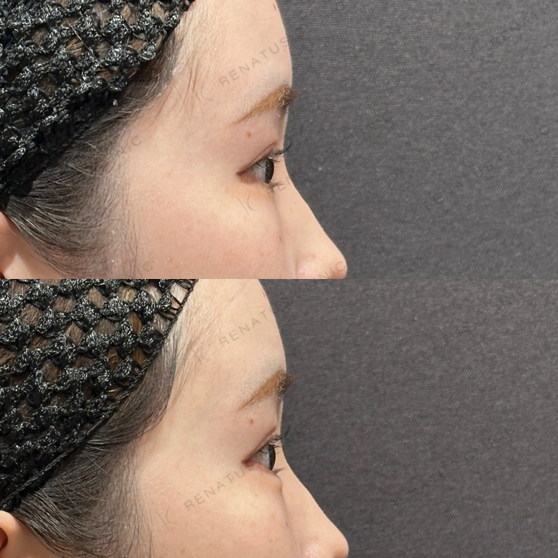 涙袋ヒアルロン酸ボルベラ症例写真 涙袋ヒアルロン酸ボルベラ症例写真