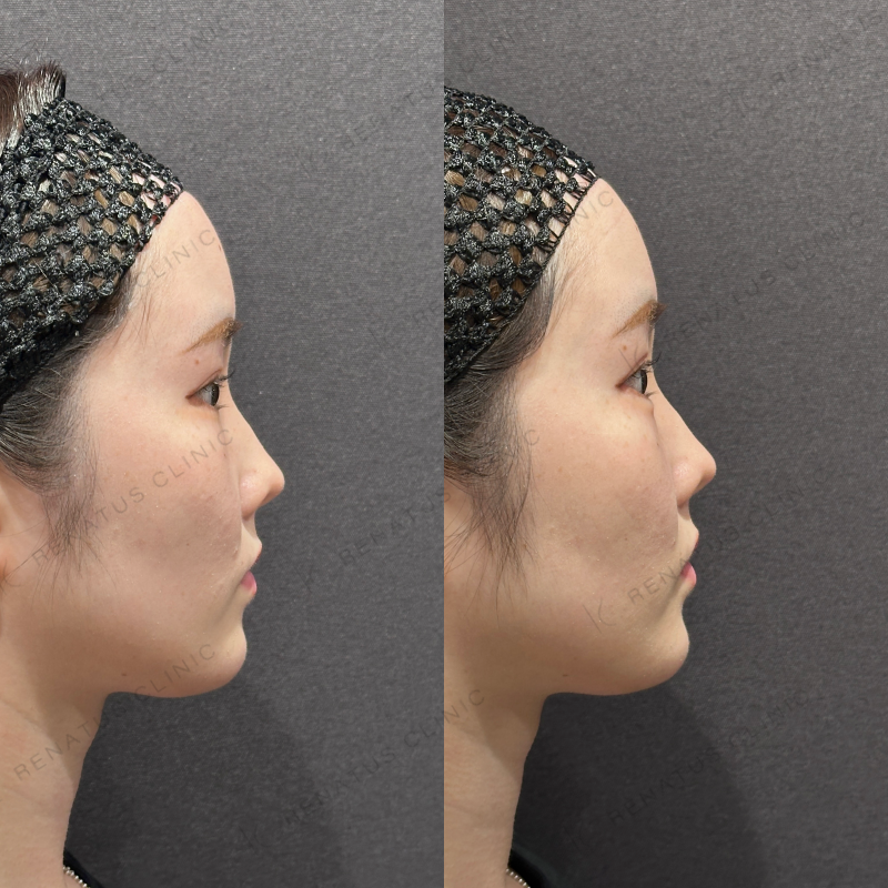 涙袋ヒアルロン酸ボルベラ症例写真 涙袋ヒアルロン酸ボルベラ症例写真