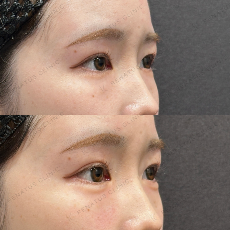 涙袋ヒアルロン酸ボルベラ症例写真 涙袋ヒアルロン酸ボルベラ症例写真