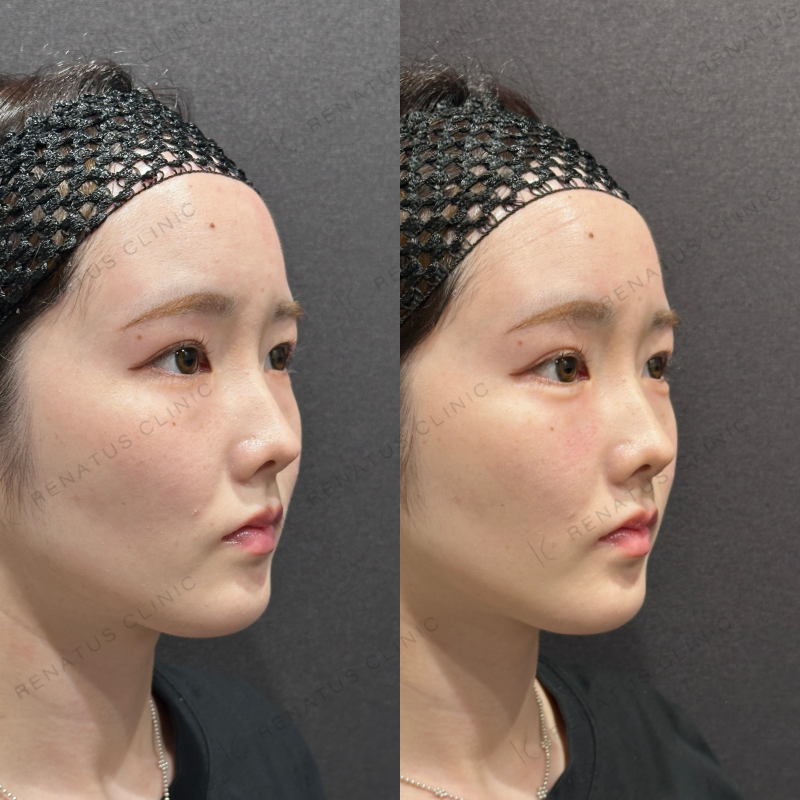 涙袋ヒアルロン酸ボルベラ症例写真 涙袋ヒアルロン酸ボルベラ症例写真