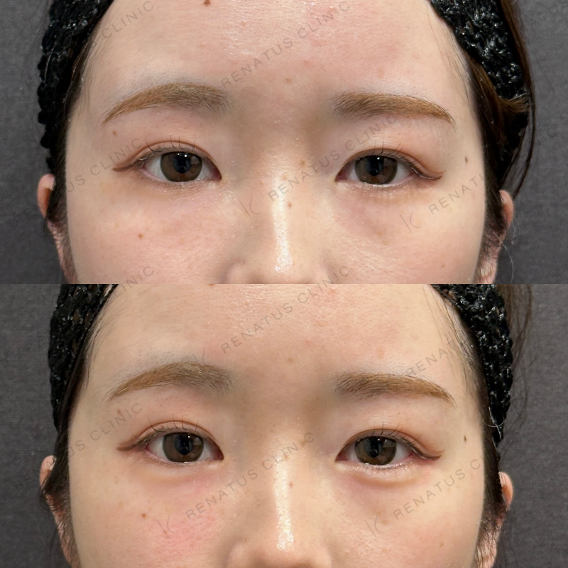 涙袋ヒアルロン酸ボルベラ症例写真 涙袋ヒアルロン酸ボルベラ症例写真