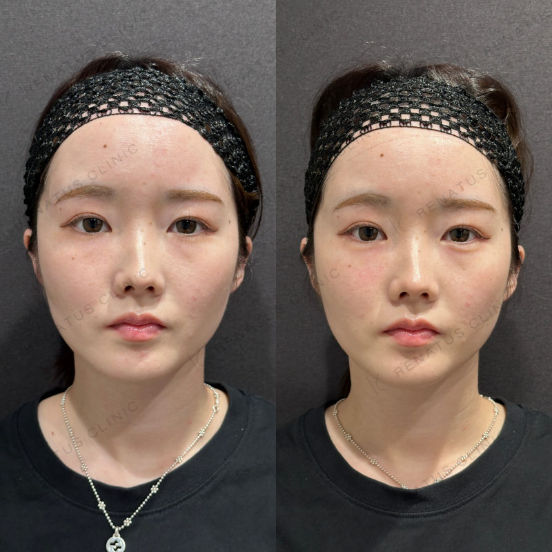 涙袋ヒアルロン酸ボルベラ症例写真 涙袋ヒアルロン酸ボルベラ症例写真