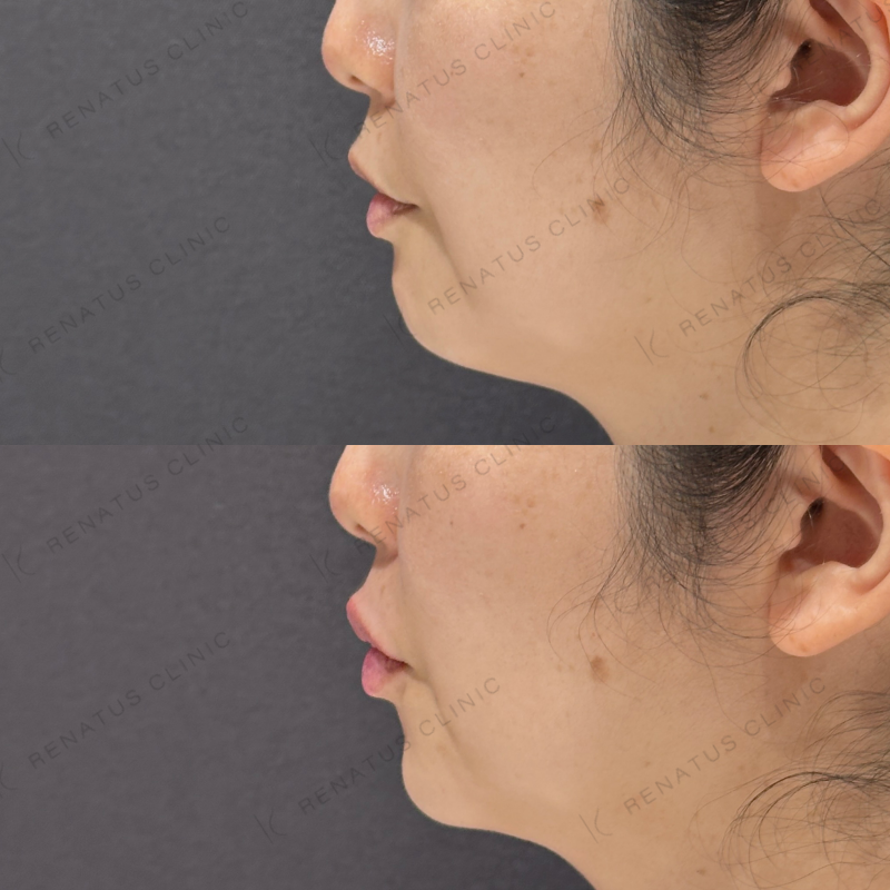 唇ヒアルロン酸ボルベラ症例写真 唇ヒアルロン酸ボルベラ症例写真