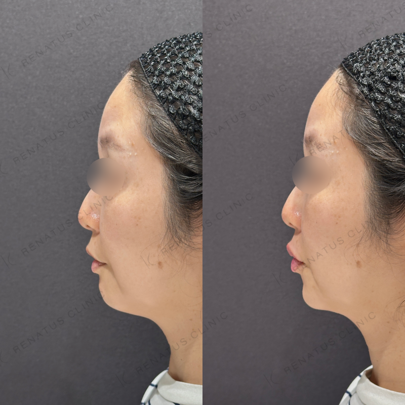 唇ヒアルロン酸ボルベラ症例写真 唇ヒアルロン酸ボルベラ症例写真