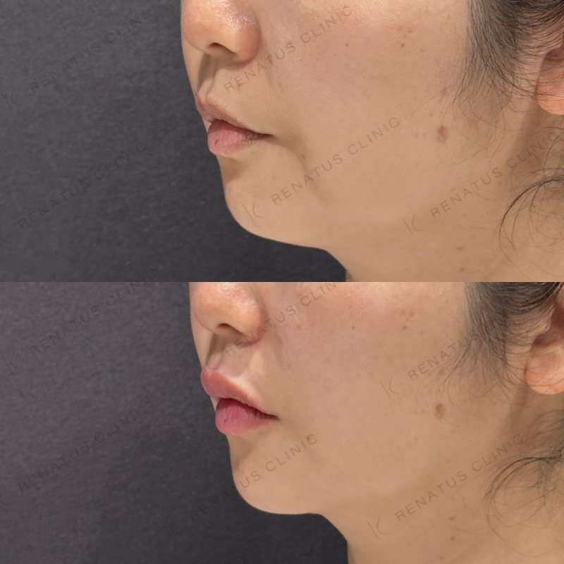 唇ヒアルロン酸ボルベラ症例写真 唇ヒアルロン酸ボルベラ症例写真