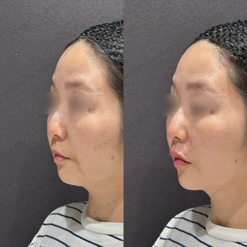 唇ヒアルロン酸ボルベラ症例写真 唇ヒアルロン酸ボルベラ症例写真