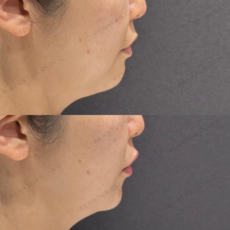 唇ヒアルロン酸ボルベラ症例写真 唇ヒアルロン酸ボルベラ症例写真