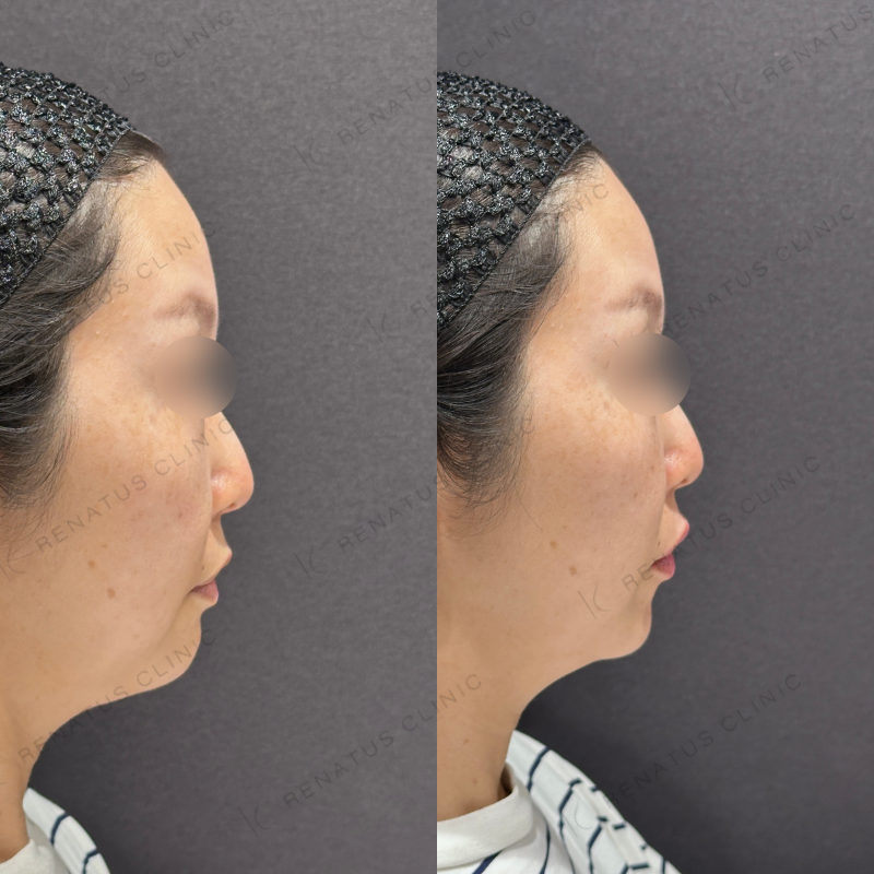 唇ヒアルロン酸ボルベラ症例写真 唇ヒアルロン酸ボルベラ症例写真