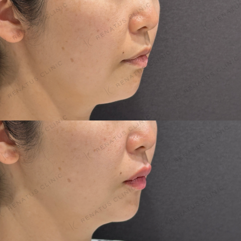 唇ヒアルロン酸ボルベラ症例写真 唇ヒアルロン酸ボルベラ症例写真