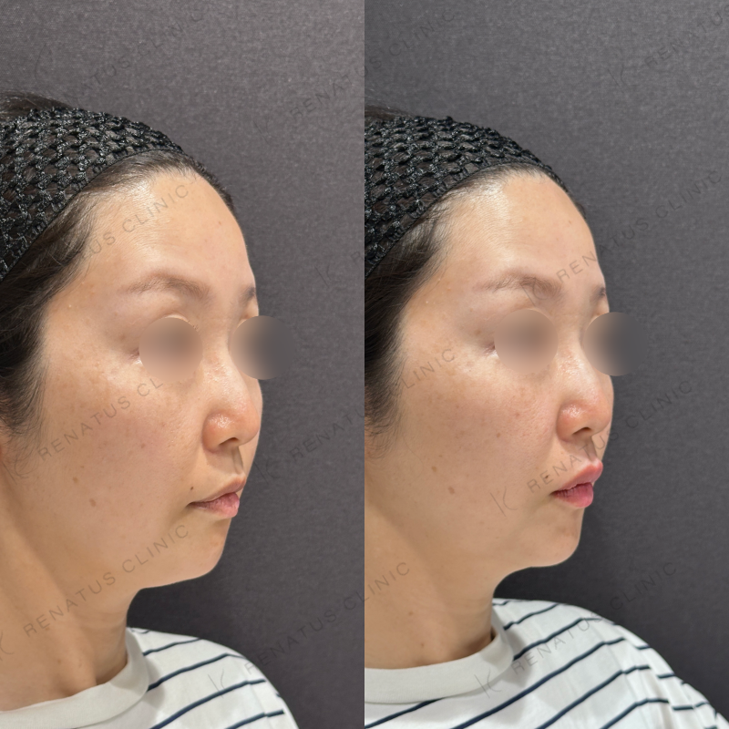 唇ヒアルロン酸ボルベラ症例写真 唇ヒアルロン酸ボルベラ症例写真