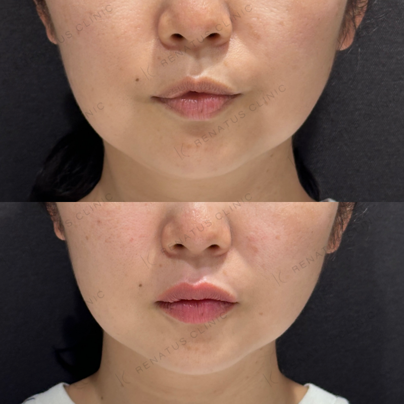 唇ヒアルロン酸ボルベラ症例写真 唇ヒアルロン酸ボルベラ症例写真