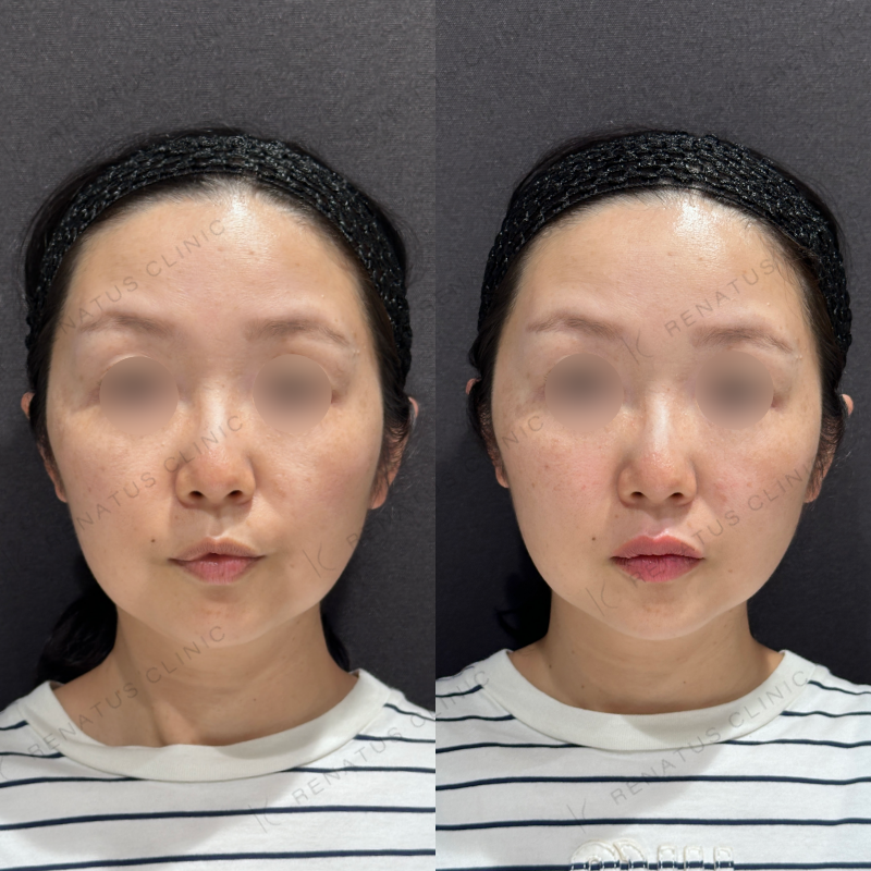 唇ヒアルロン酸ボルベラ症例写真 唇ヒアルロン酸ボルベラ症例写真