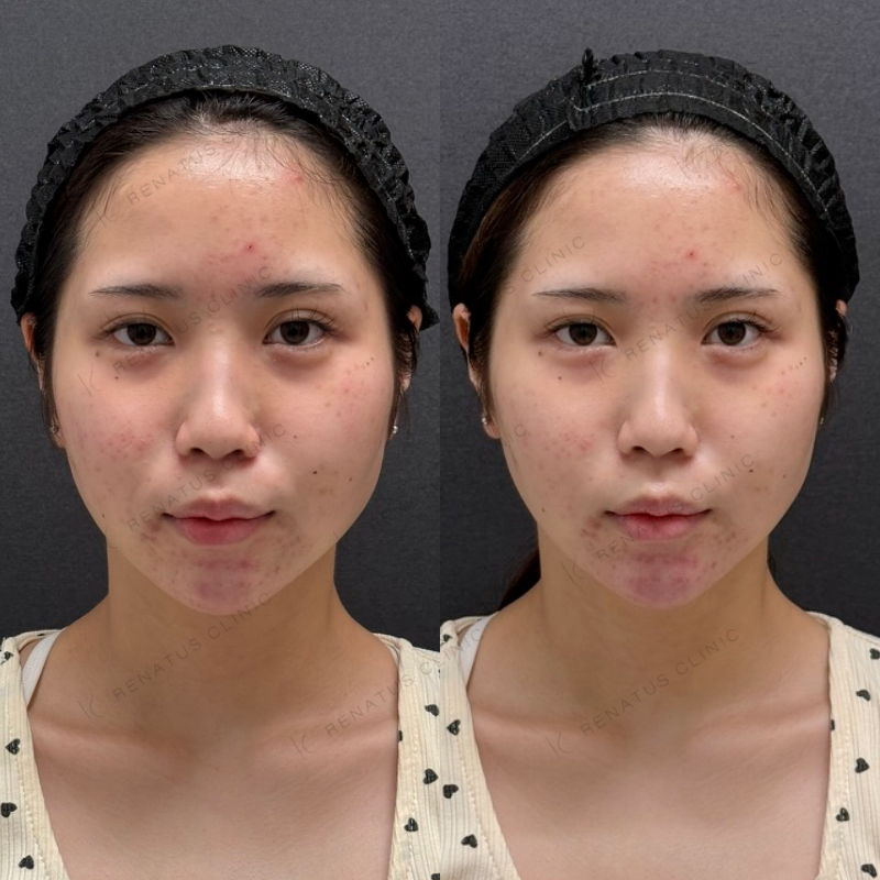 福岡_848_松村Dr_顎_ボラックス_女性_20_正面 顎ヒアルロン酸ボラックス症例写真