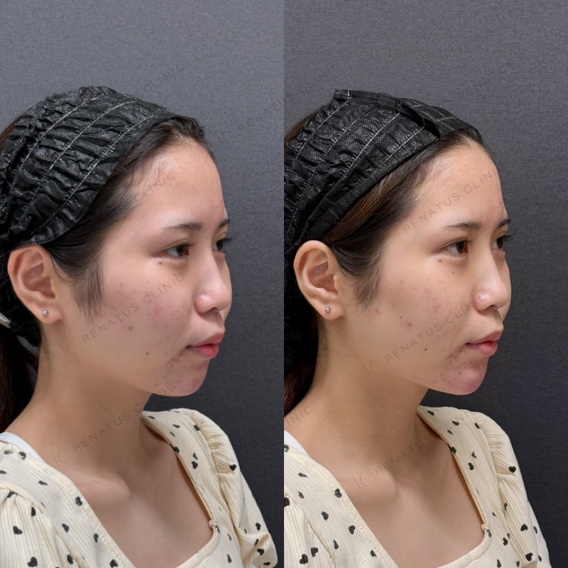 福岡_848_松村Dr_顎_ボラックス_女性_20_斜め右 顎ヒアルロン酸ボラックス症例写真