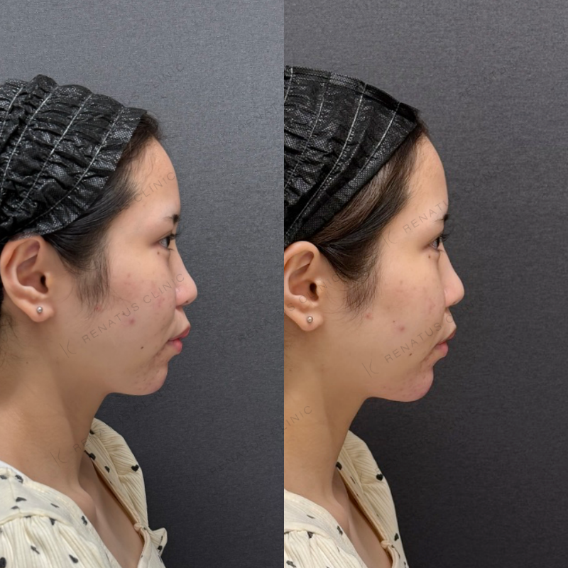 福岡_848_松村Dr_顎_ボラックス_女性_20_右 顎ヒアルロン酸ボラックス症例写真