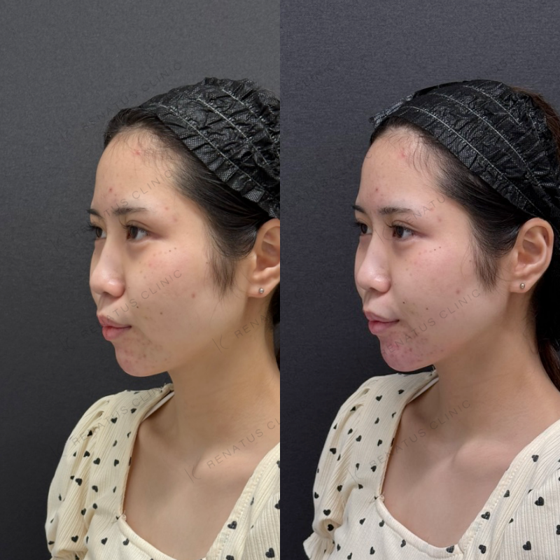 福岡_848_松村Dr_顎_ボラックス_女性_20_斜め左 顎ヒアルロン酸ボラックス症例写真