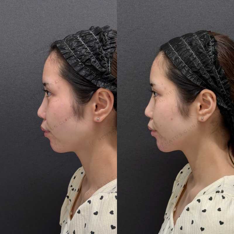 福岡_848_松村Dr_顎_ボラックス_女性_20_左 顎ヒアルロン酸ボラックス症例写真