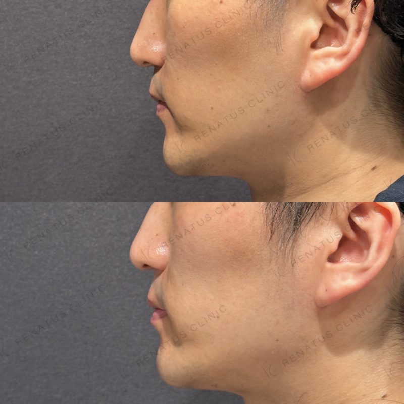 糸リフト症例写真 糸リフト症例写真