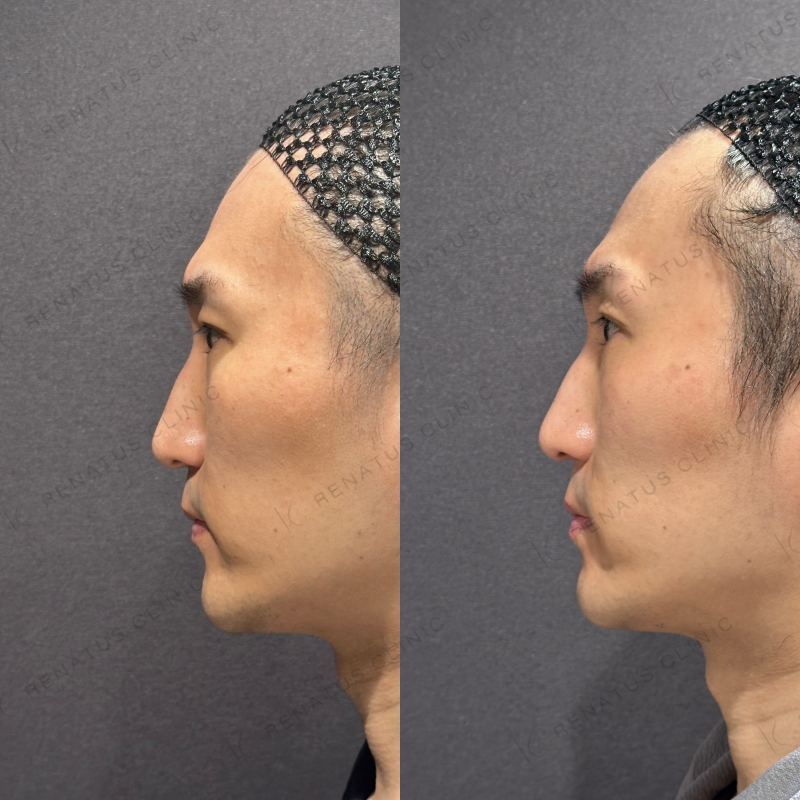 糸リフト症例写真 糸リフト症例写真