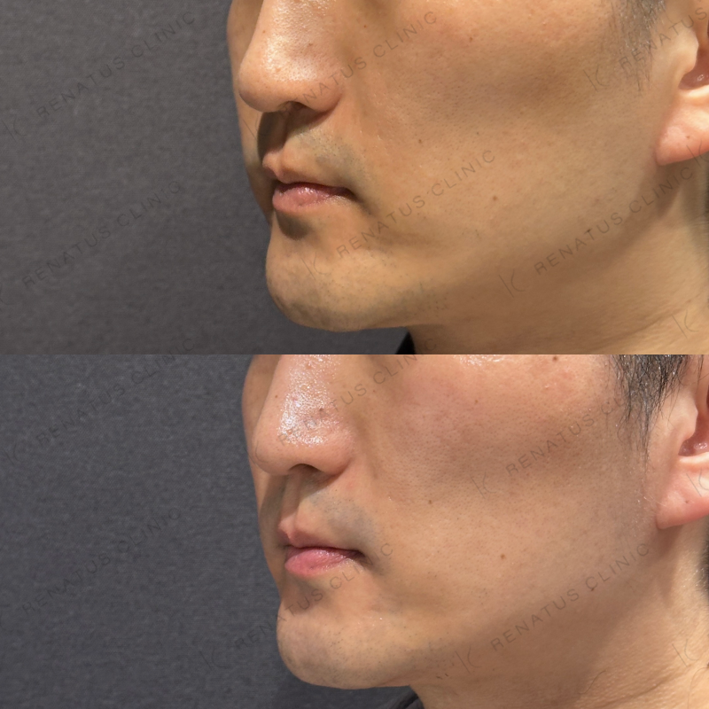 糸リフト症例写真 糸リフト症例写真