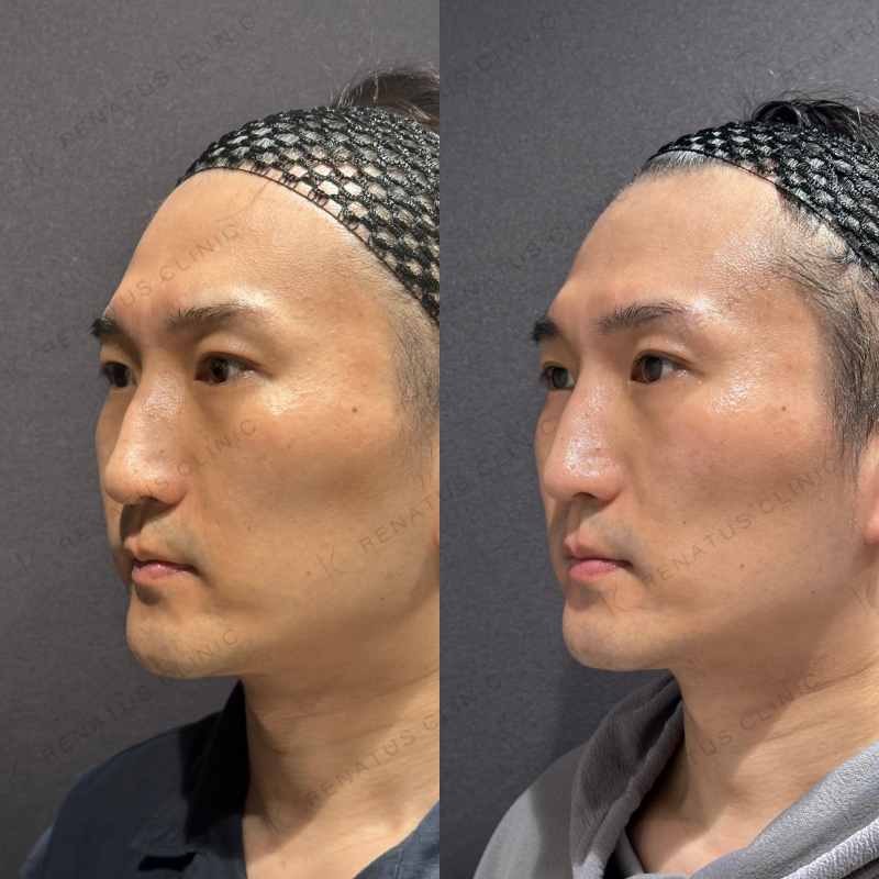 糸リフト症例写真 糸リフト症例写真