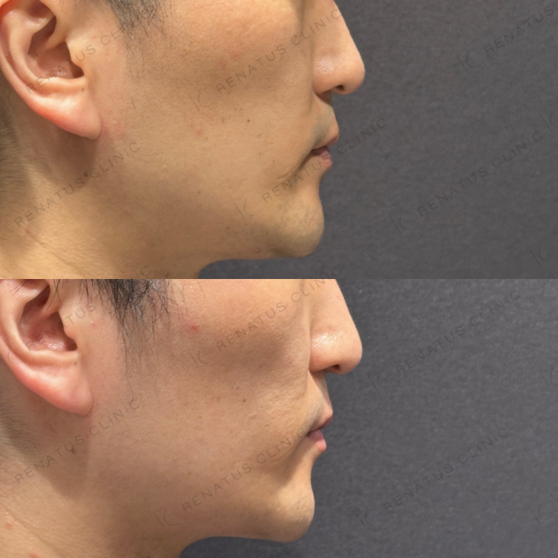 糸リフト症例写真 糸リフト症例写真