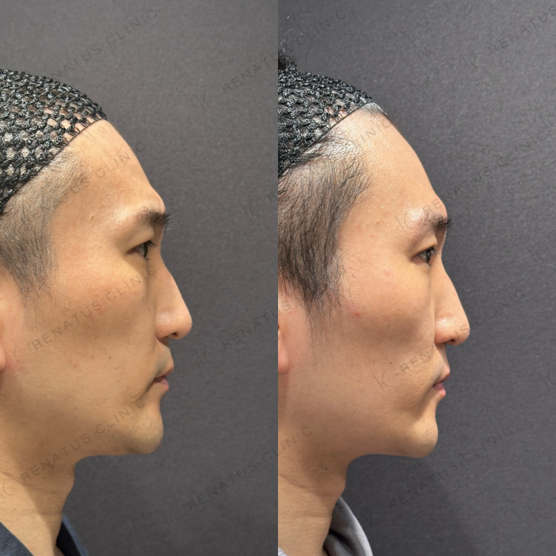 糸リフト症例写真 糸リフト症例写真